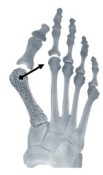 Transverse plane correction with osteo-WEDGE 1
