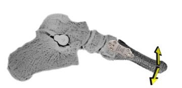 sagittal plane correction with osteo-WEDGE