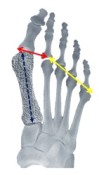 shorten a long metatarsal with osteo-WEDGE
