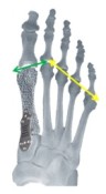 shorten a long metatarsal with osteo-WEDGE